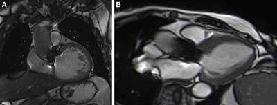 Is there a role for cardiovascular magnetic resonance imaging in the assessment of biological aortic valves?